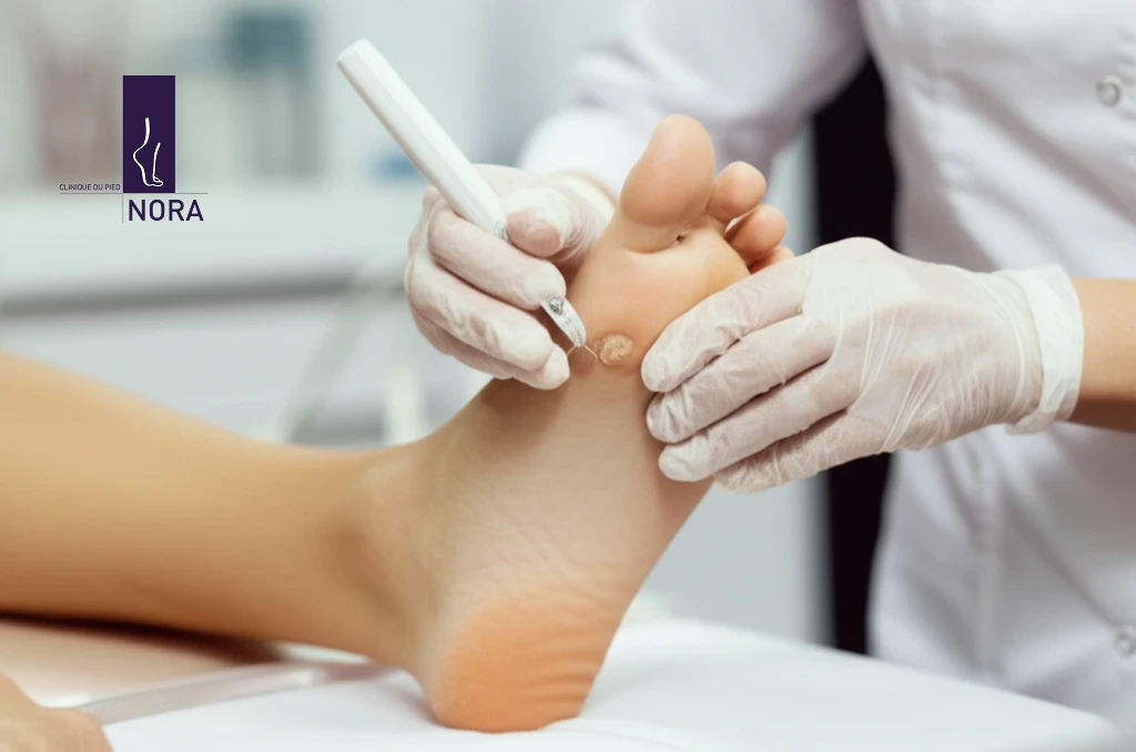 Traitement des cors et callosités