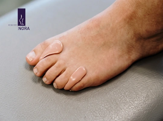 Orthoplastie — Orthèses sur mesure pour orteils — NORA Clinique du Pied